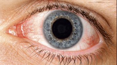 El síntoma en los ojos que revela que tienes elevado el azúcar en la sangre